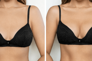 Augmentation mammaire naturelle par lipofilling : tout savoir sur cette alternative douce aux implants